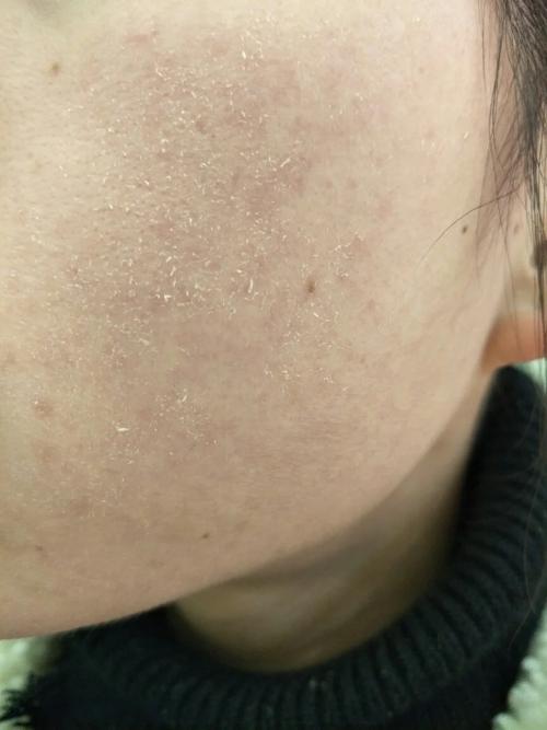 雅漾洗面奶用完脱皮