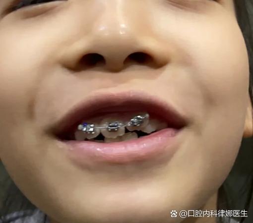 牙齿为什么会歪