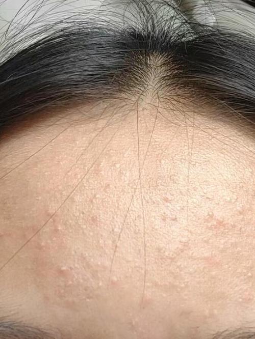 闭口是什么图片