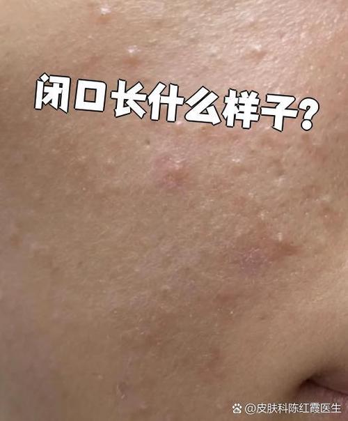 闭口是什么图片