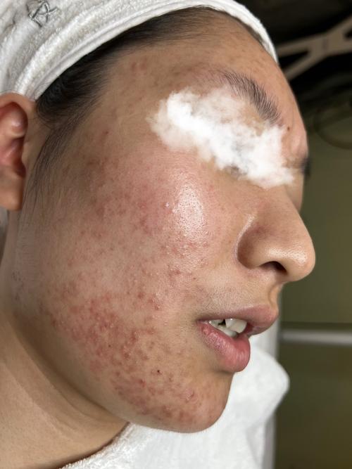 闭口是什么图片