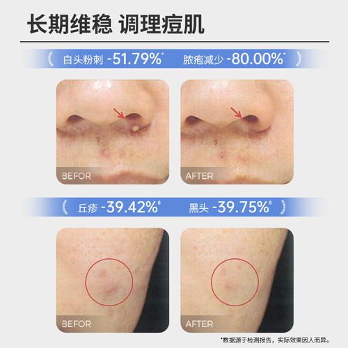 什么洗面奶祛痘清洁