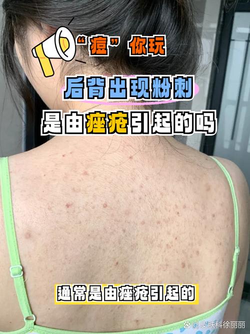 后背长痘痘什么原因