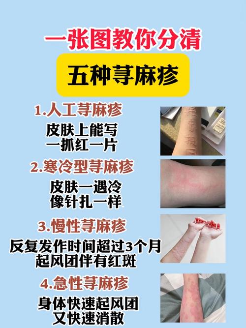 荨麻疹什么意思