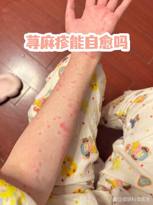 荨麻疹什么意思