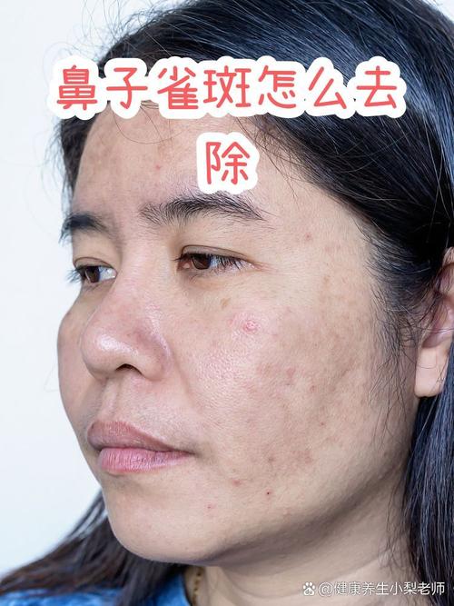 洗面奶会加重雀斑吗
