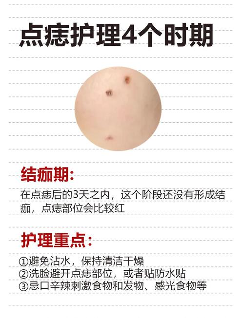 点痣后注意什么