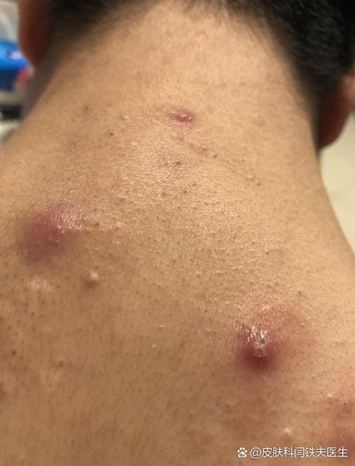 皮肤结节是什么