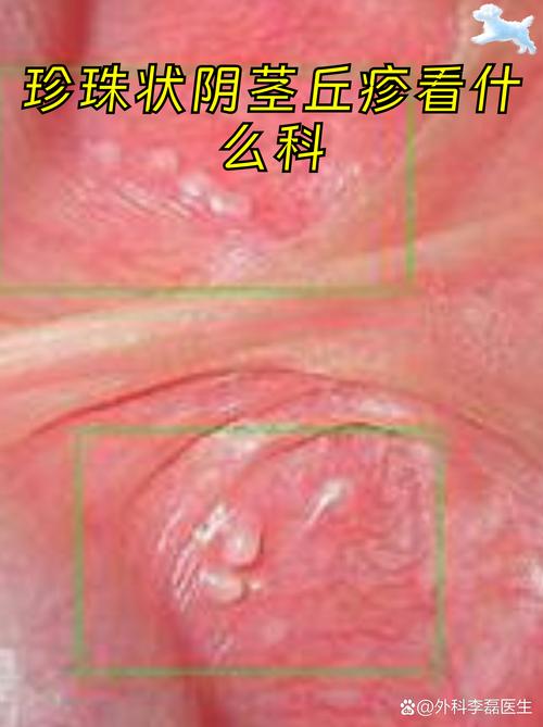 丘疹是什么样的