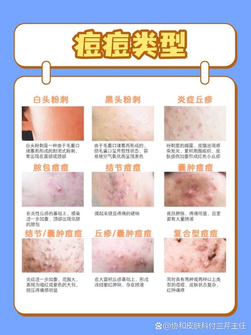 长痘痘是因为什么