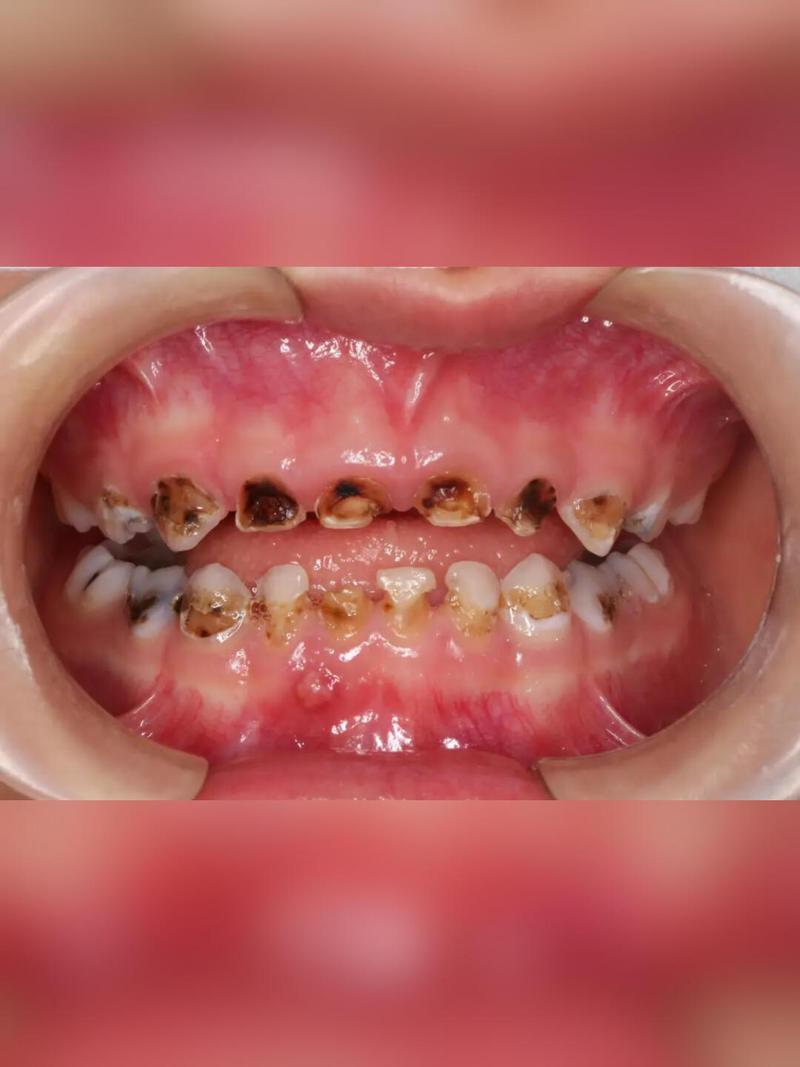 蛀牙什么症状