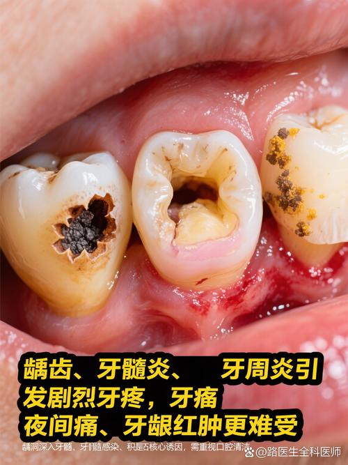 蛀牙什么症状