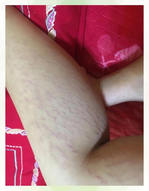 什么是妊娠纹