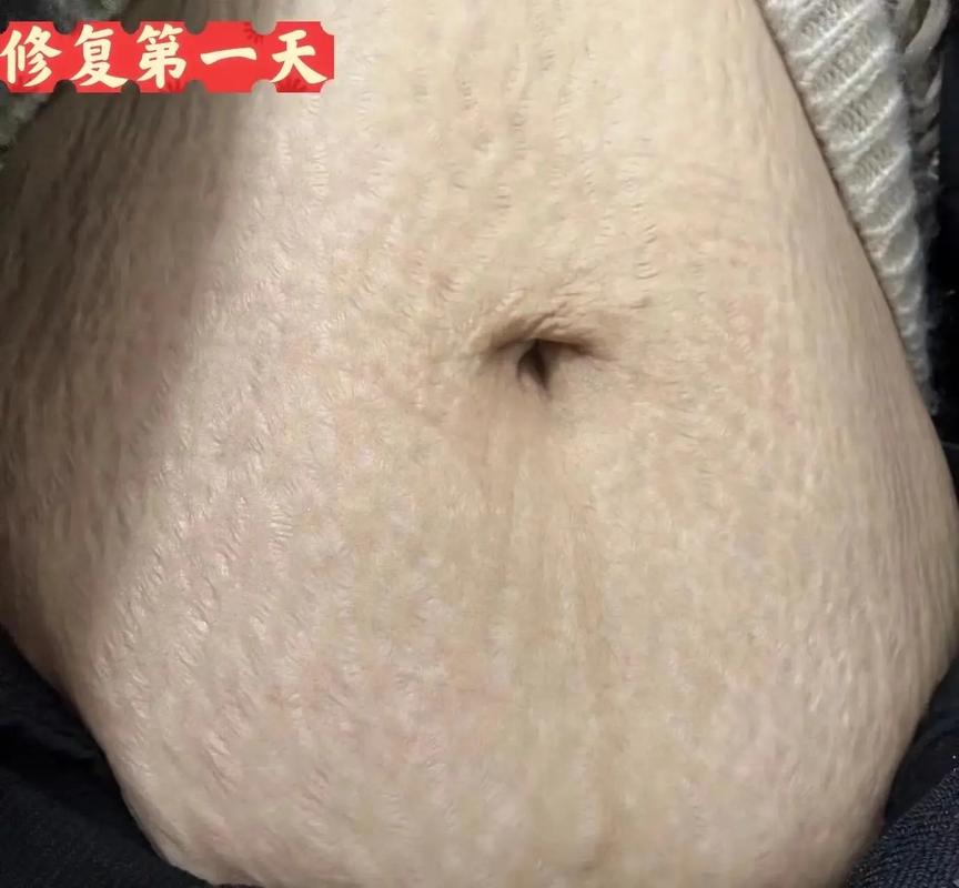 什么是妊娠纹