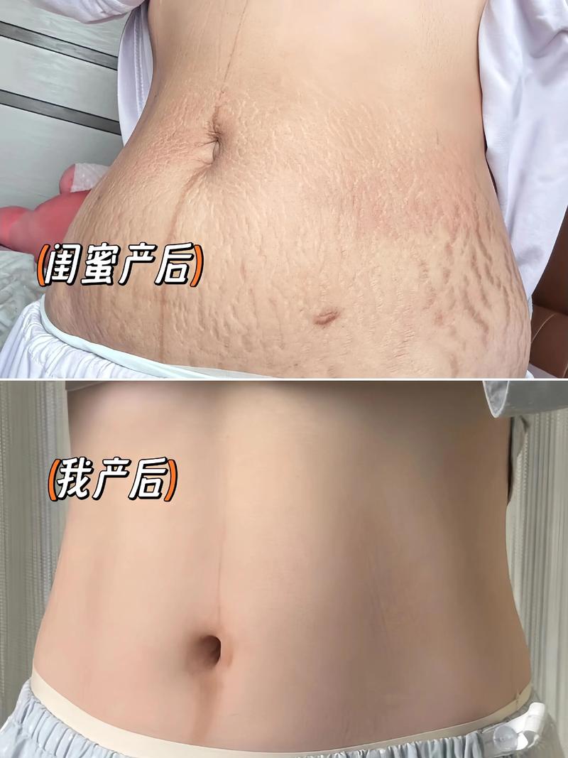 什么是妊娠纹